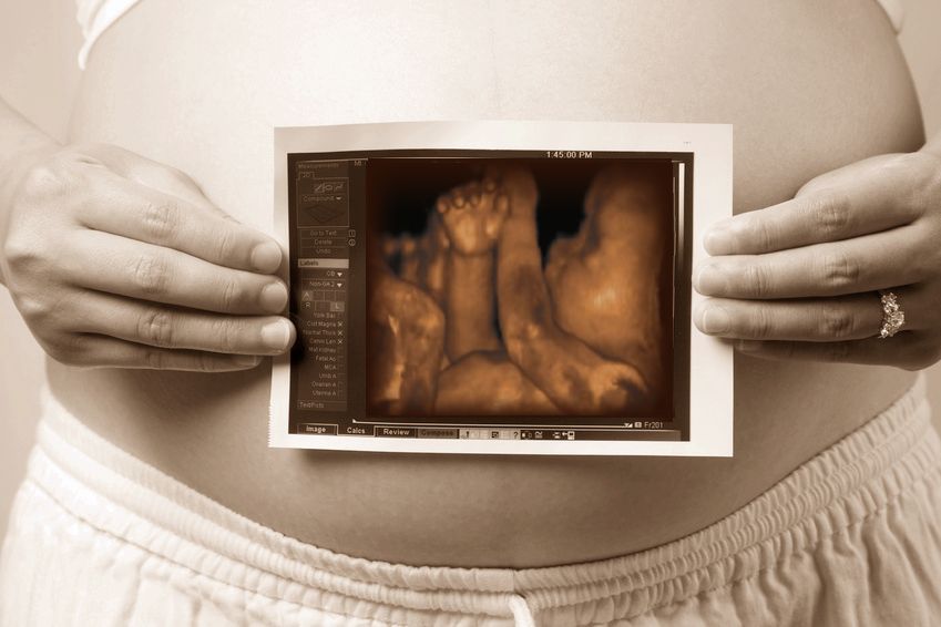 3D Ultrasound Photo